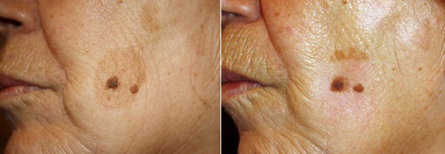 Laser CO2 Macchia viso